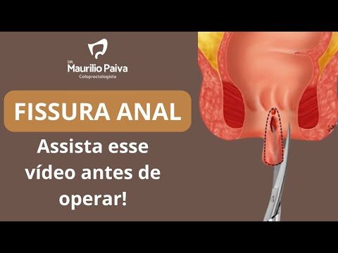 Recupera&ccedil;&atilde;o Eficiente Ap&oacute;s Cirurgia de Fissura Retal