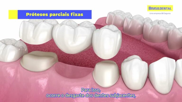 Tipos de Pr&oacute;tese Dent&aacute;ria: Guia Completo para Escolhas e Benef&iacute;cios