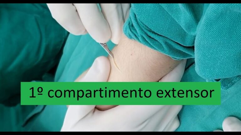 Tratamento Cir&uacute;rgico da Tenossinovite de Quervain