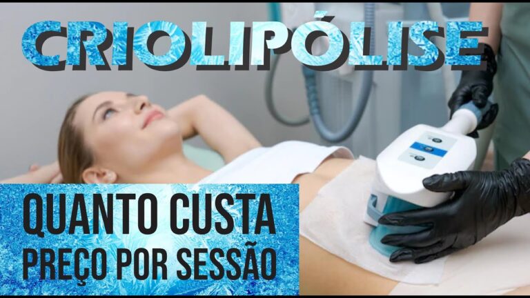 Criolip&oacute;lise: Pre&ccedil;o por Sess&atilde;o e Benef&iacute;cios