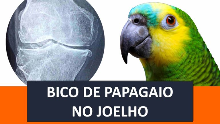 Tratamento Eficaz para Bico de Papagaio no Joelho