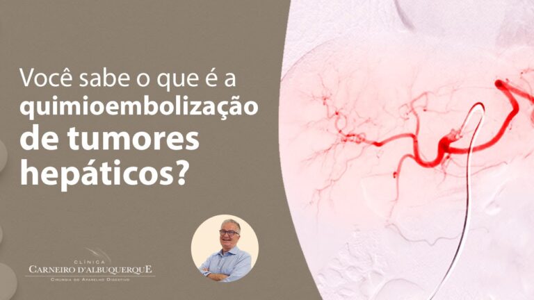 Avanços na Embolização Tumoral: Tratamentos e Resultados