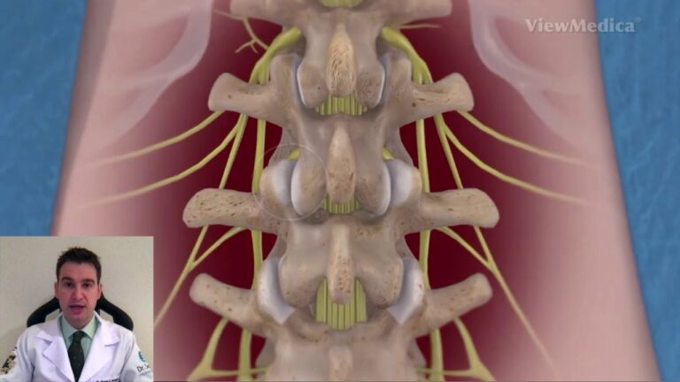 Cirurgia de Coluna Lombar com Parafusos: Benef&iacute;cios e Cuidados