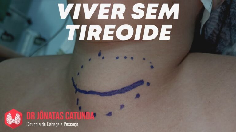 Consequ&ecirc;ncias da Retirada da Tireoide