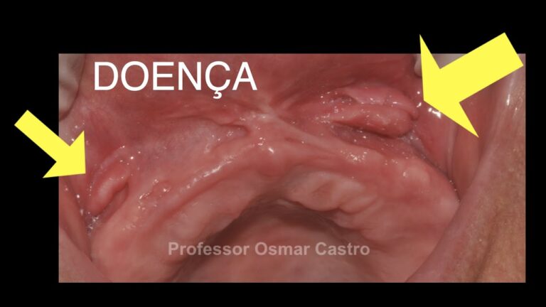 Como Evitar a Inflamação em Prótese Dentária