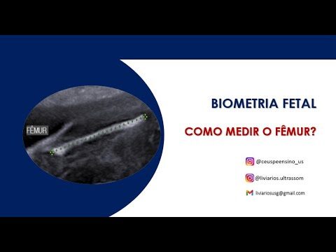 Como Calcular o Comprimento do Beb&ecirc; pelo F&ecirc;mur