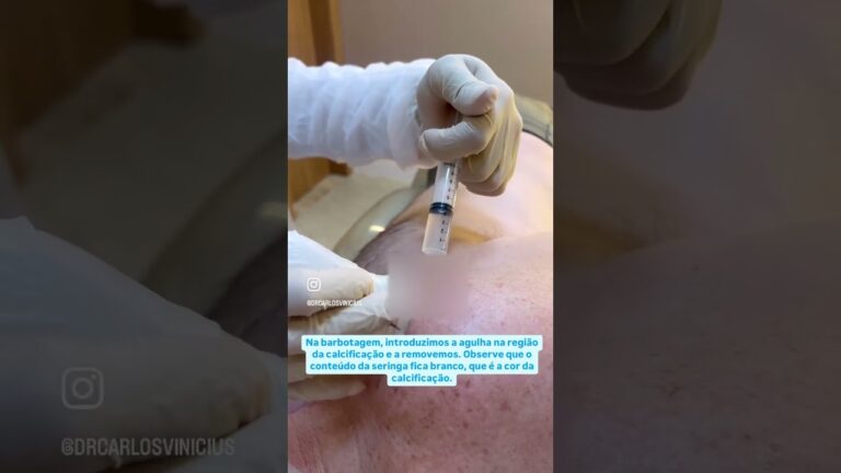 Tendinite Calcificada no Ombro: Causas e Tratamentos Eficazes