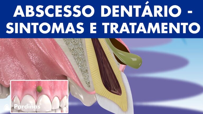 Al&iacute;vio Eficaz para o Dor de Dentes com Clonix
