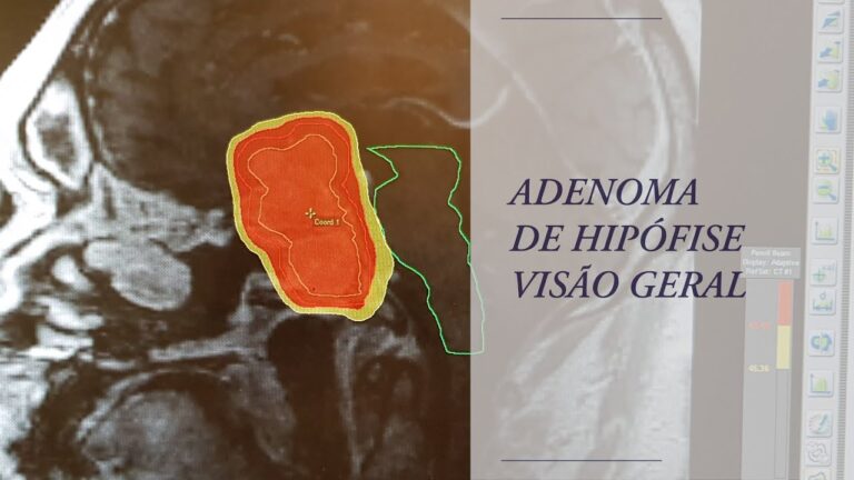 Entendendo o Adenoma na Hip&oacute;fise: Causas e Tratamentos