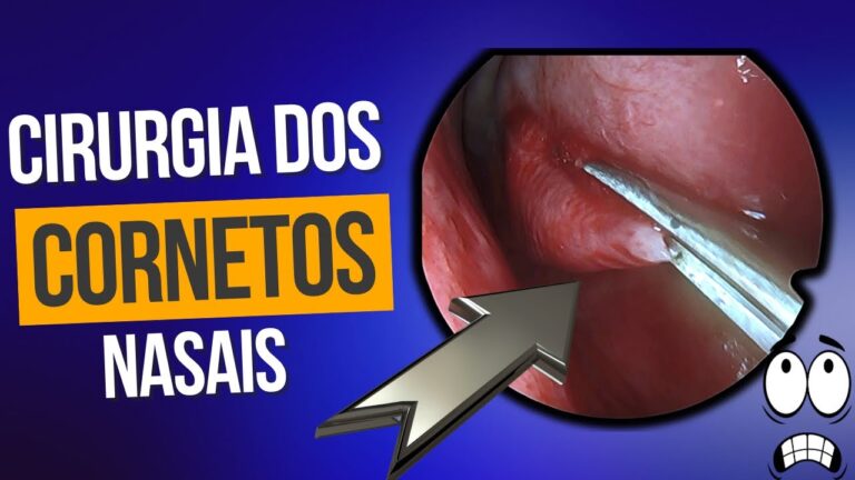 Recupera&ccedil;&atilde;o Eficiente Ap&oacute;s Cirurgia de Cornetos Nasais