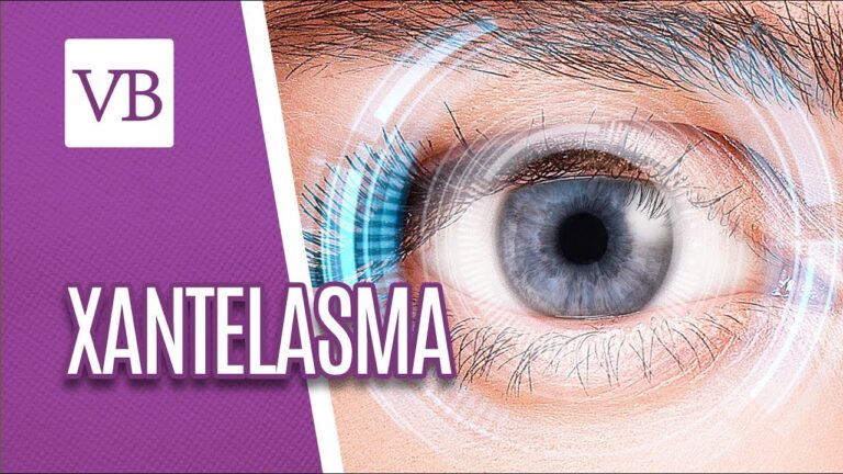 Xantelasma: Entenda as Imagens e Tratamentos Disponíveis