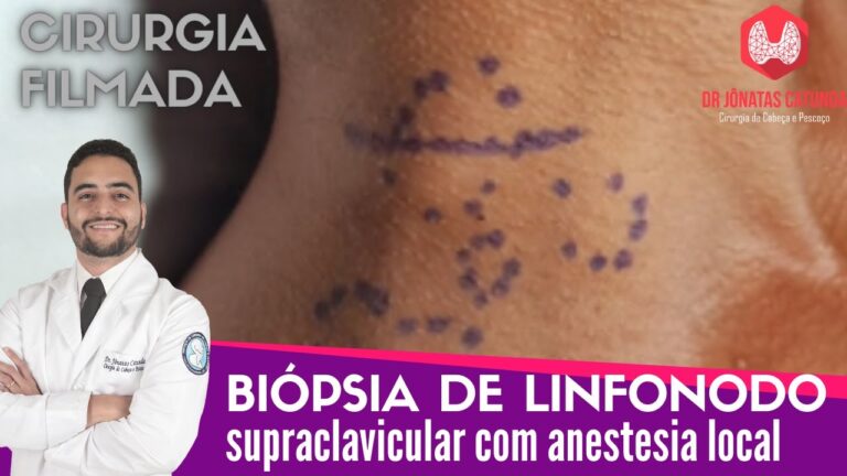 Importância da Biopsia do Gânglio Supraclavicular na Diagnóstico Oncológico