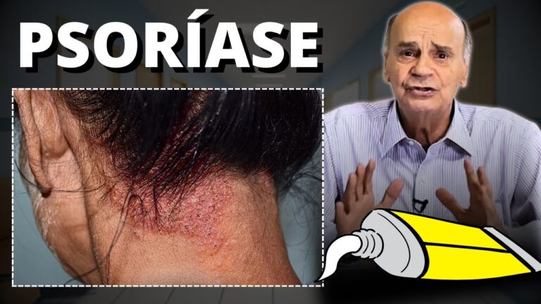 Melhor Creme Hidratante para Psor&iacute;ase: Op&ccedil;&otilde;es Eficazes