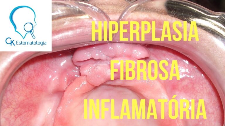 Causas da Hipertrofia Gengival