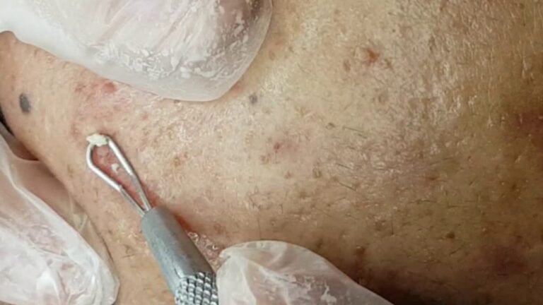 Limpeza de Pele: A Solução para Espinhas