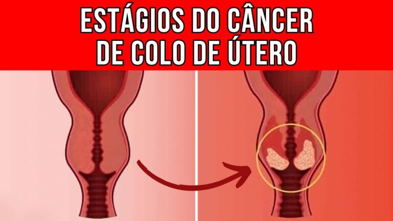 C&acirc;ncer de Colo Uterino Grau 4: Possibilidades de Cura