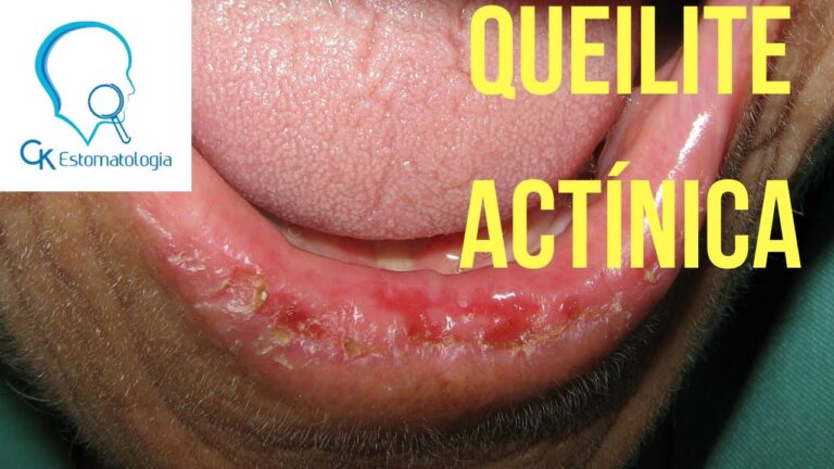 Queilite Actínica: Causas, Sintomas e Tratamentos