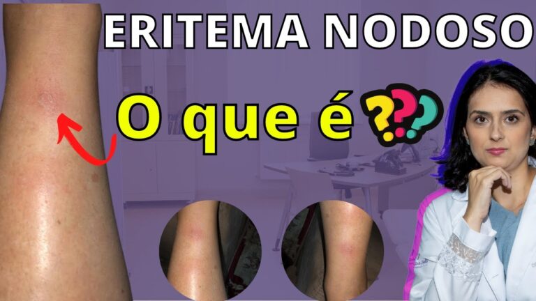 Causas do Eritema Nodoso: Entenda os Fatores Desencadeantes