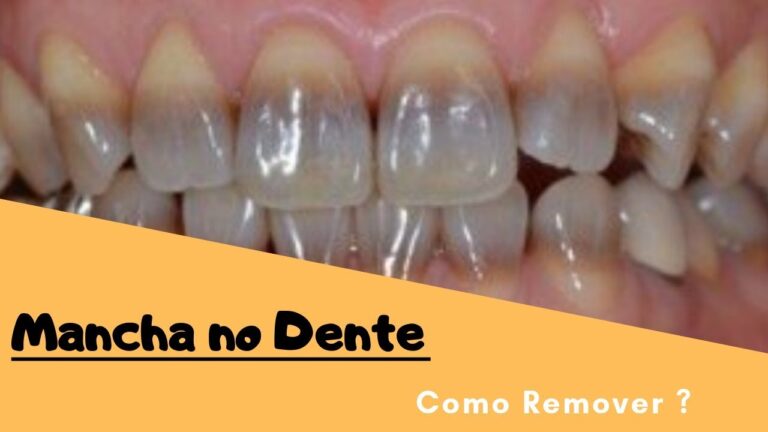 Como Remover Manchas dos Dentes Eficazmente